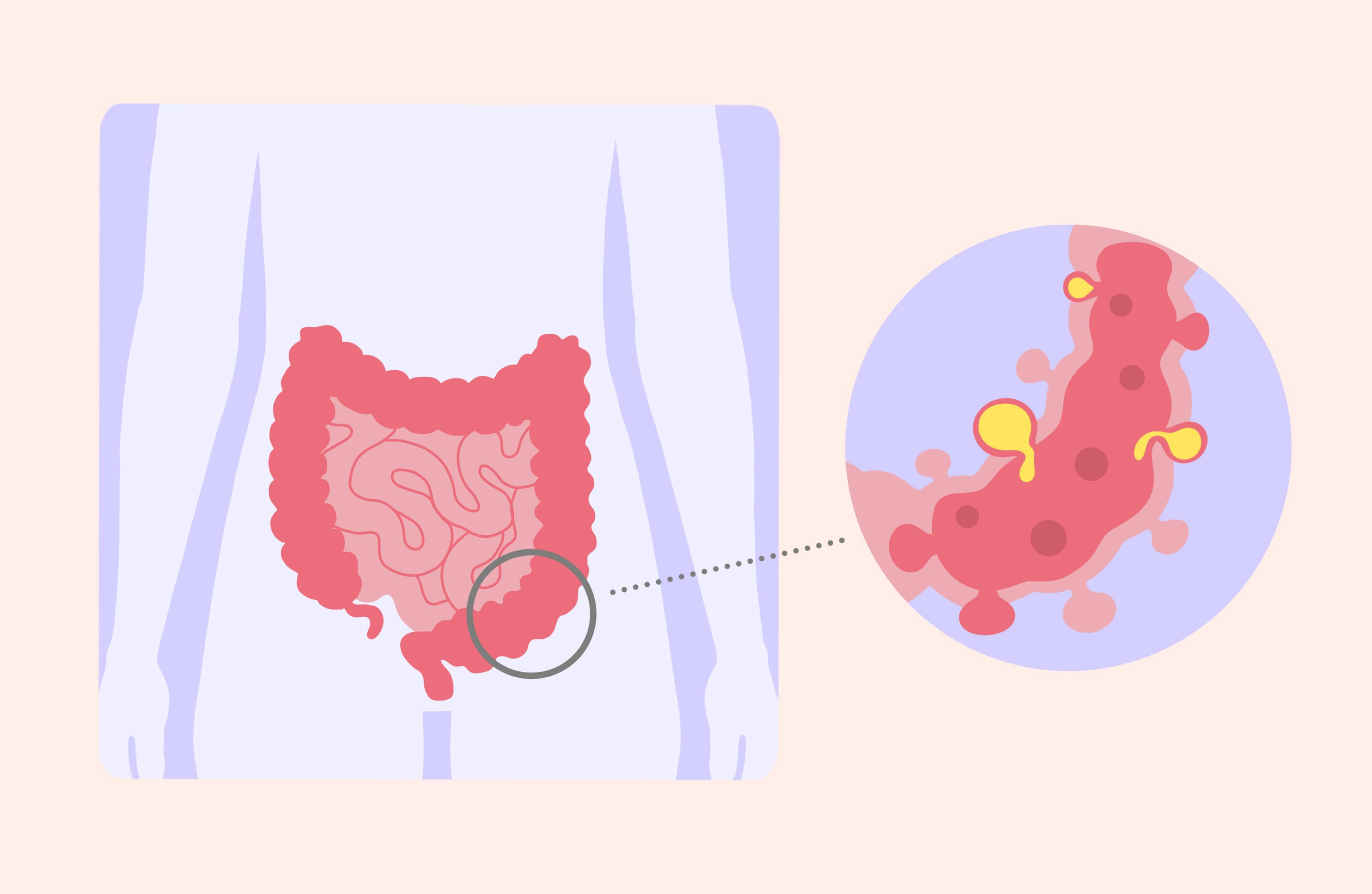 Causes de la diverticulite