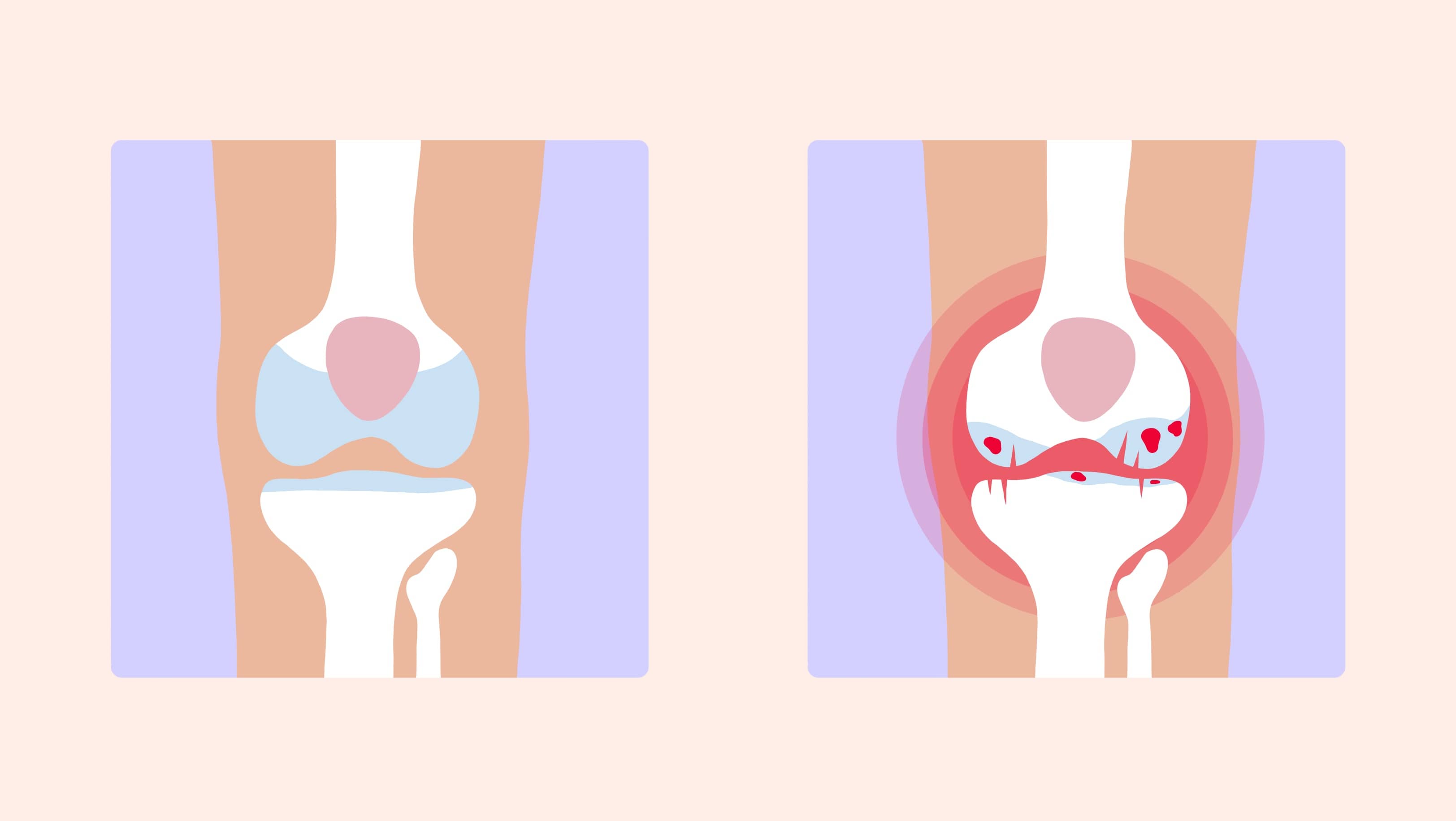 Arthrose : où se manifeste-telle ?