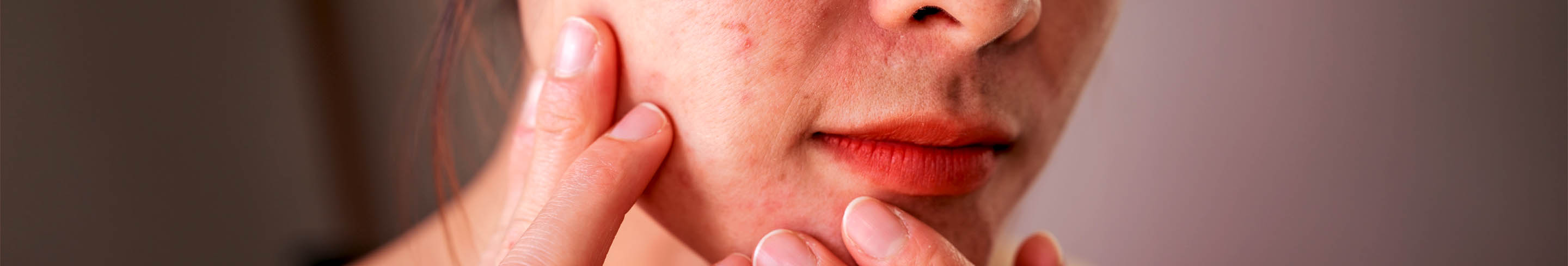 Imperfections de la peau – le guide complet contre les points noirs et les boutons