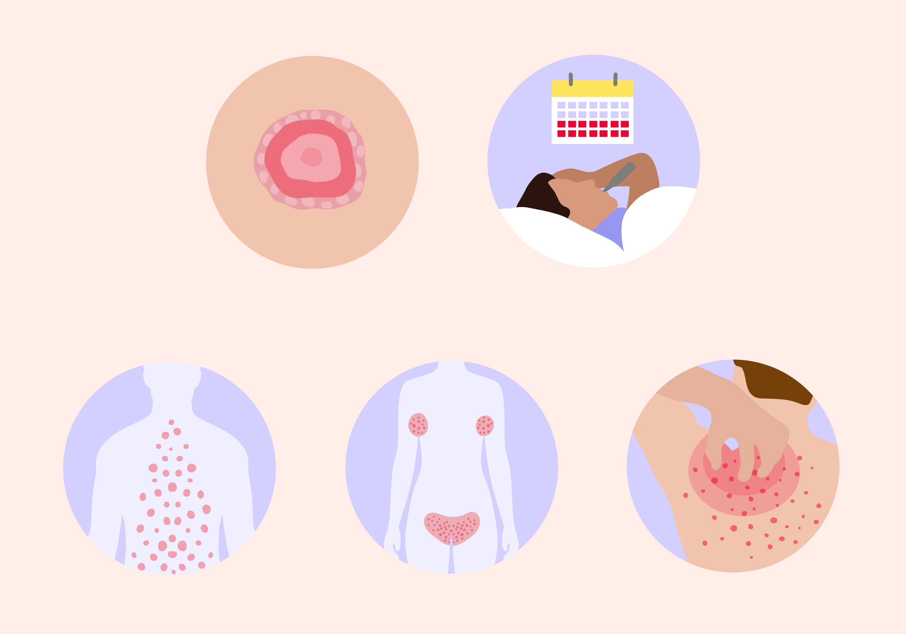 pityriasis rose symptômes