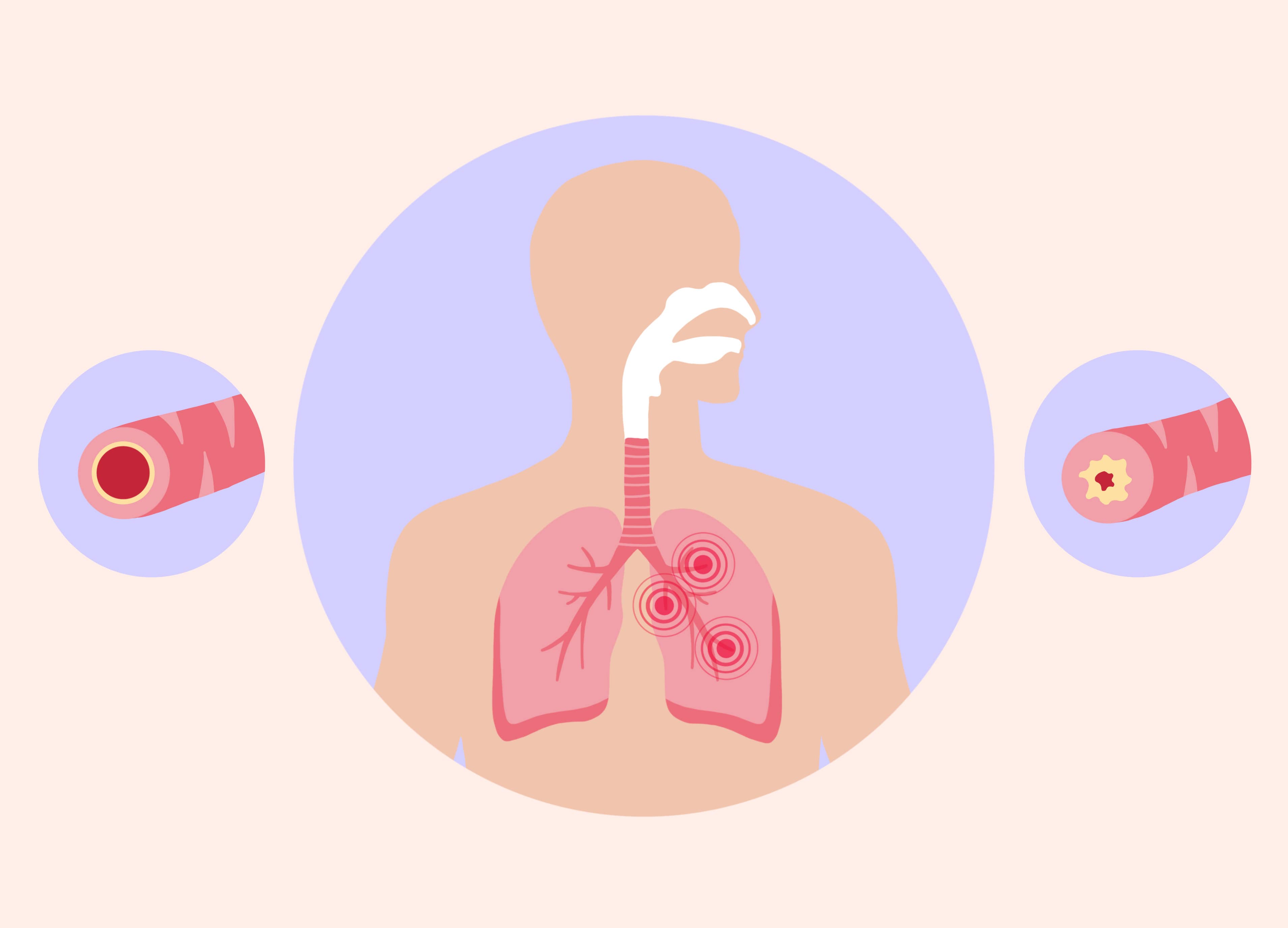 bronchitis behandlung