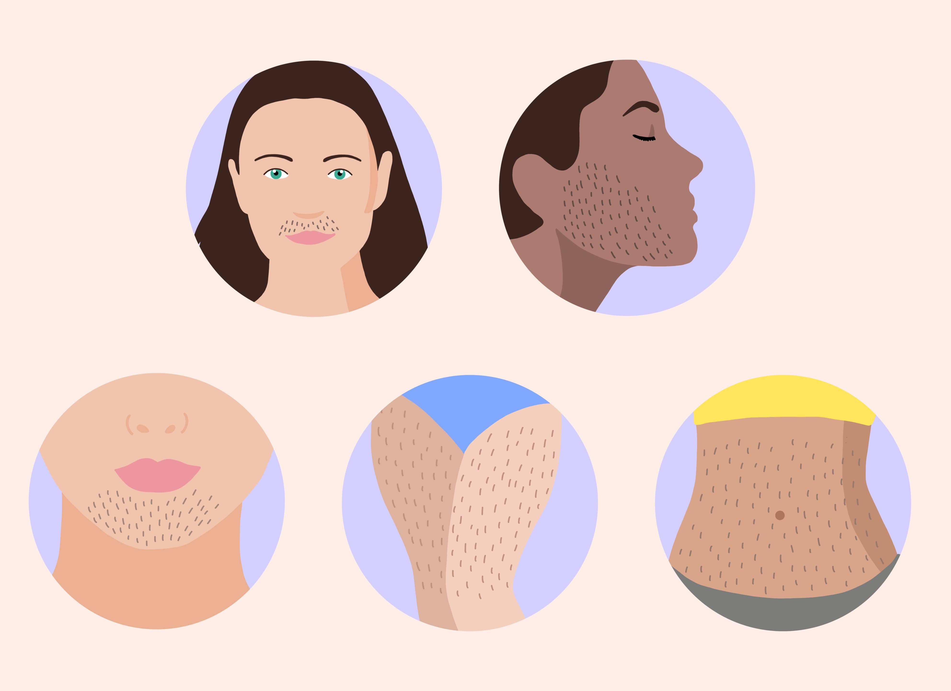 Hirsutismus Symptome