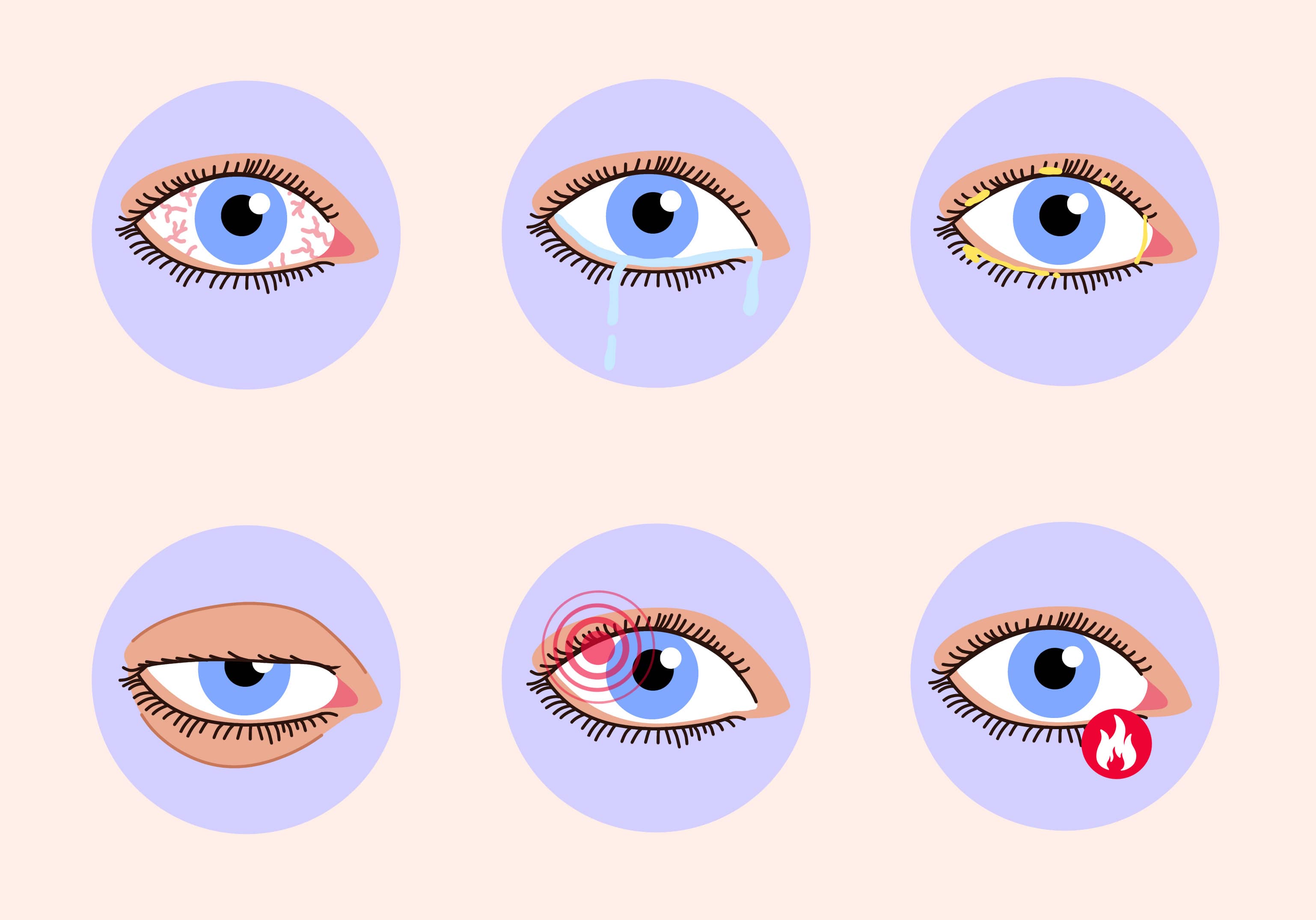 trockene augen symptome