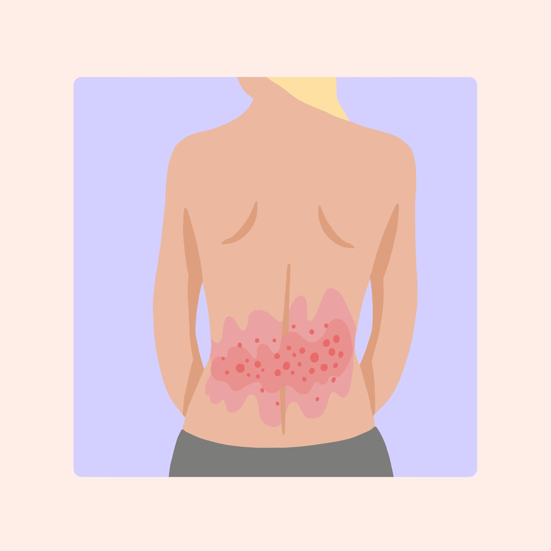 wie sieht gürtelrose aus