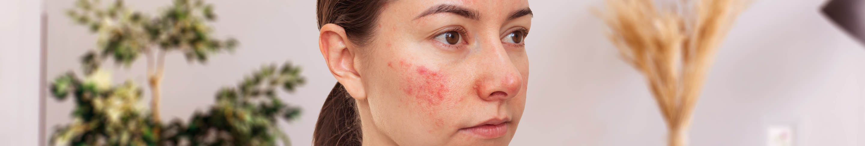 lupus erythematodes header