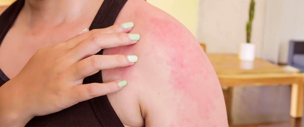 Allergie au soleil - Qu'est-ce que la photodermatose et comment la traite-t-on ?