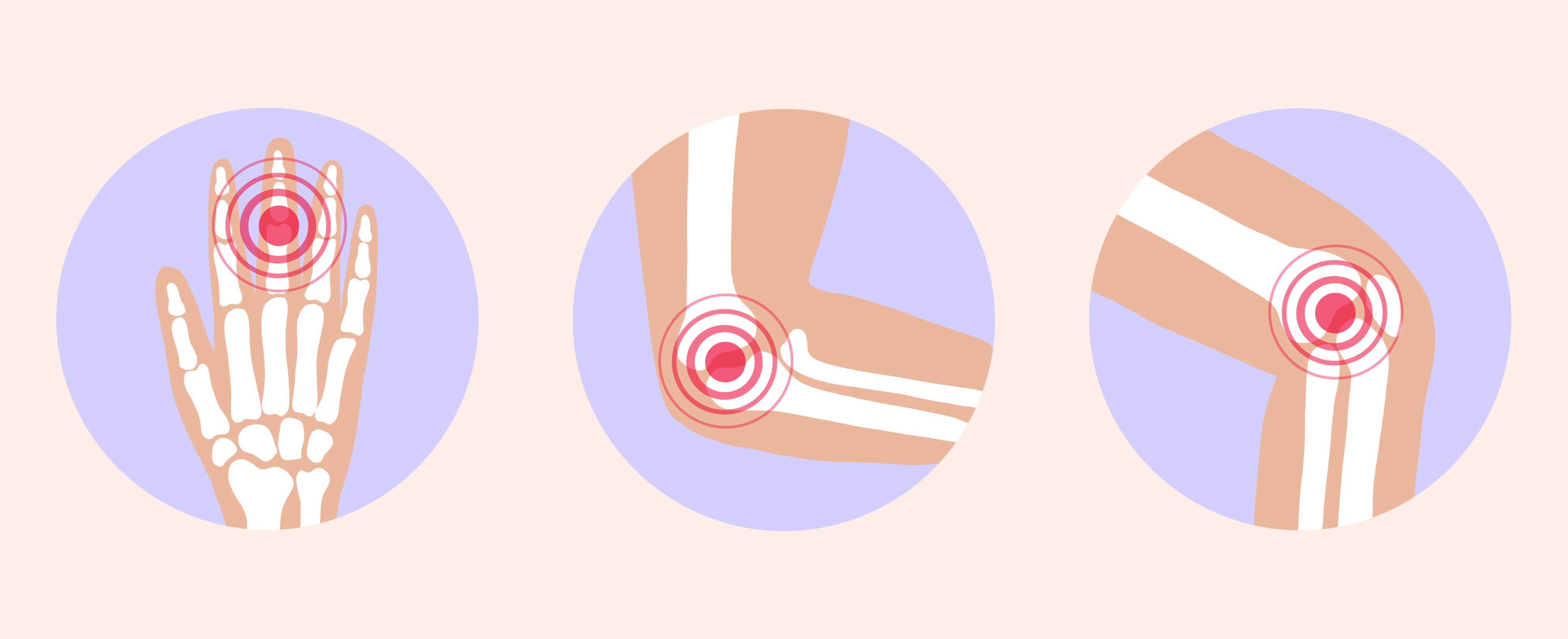 Symptômes de l’arthrite