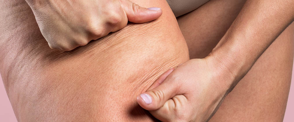 Cellulite - Wat helpt tegen een zwak bindweefsel?