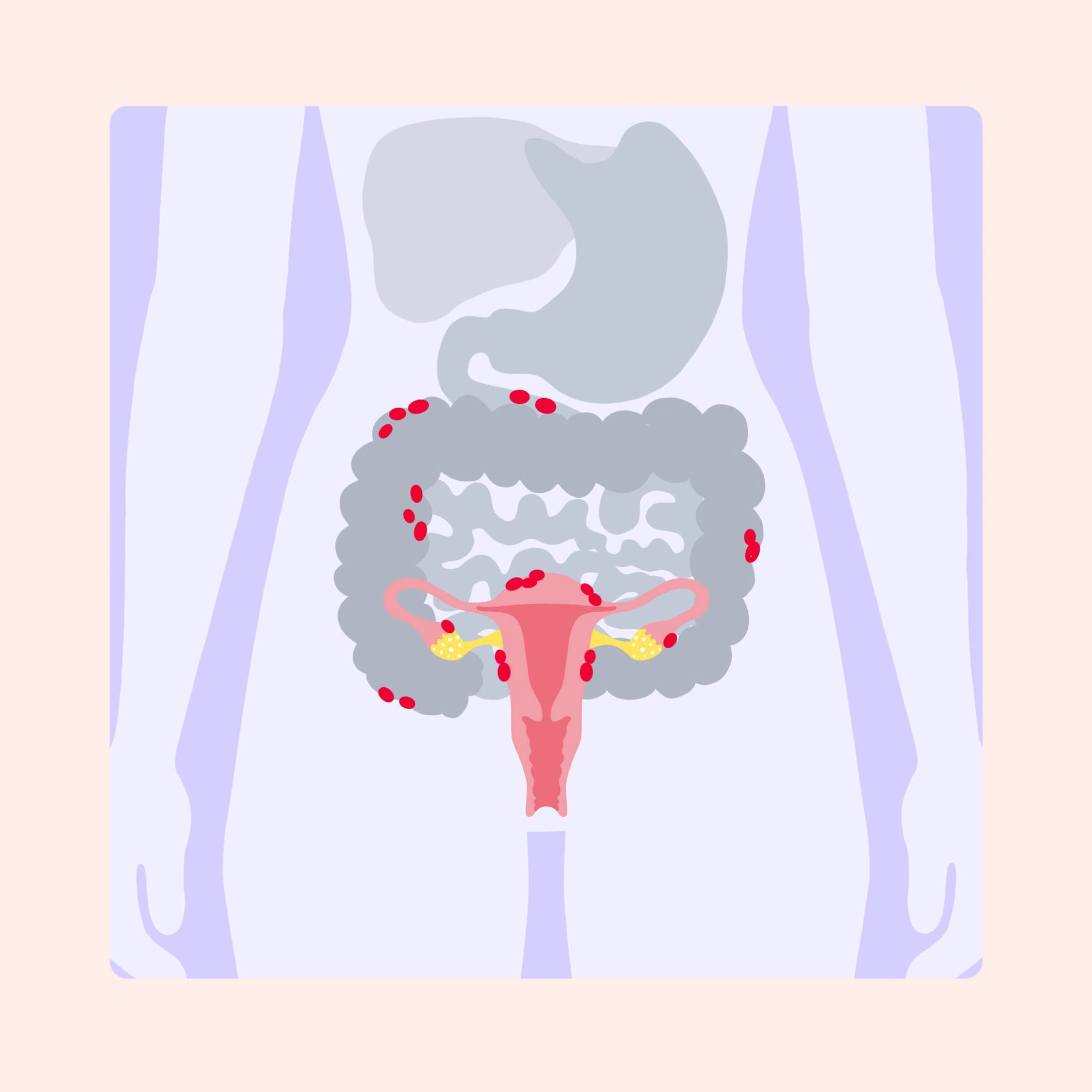 Endometriose