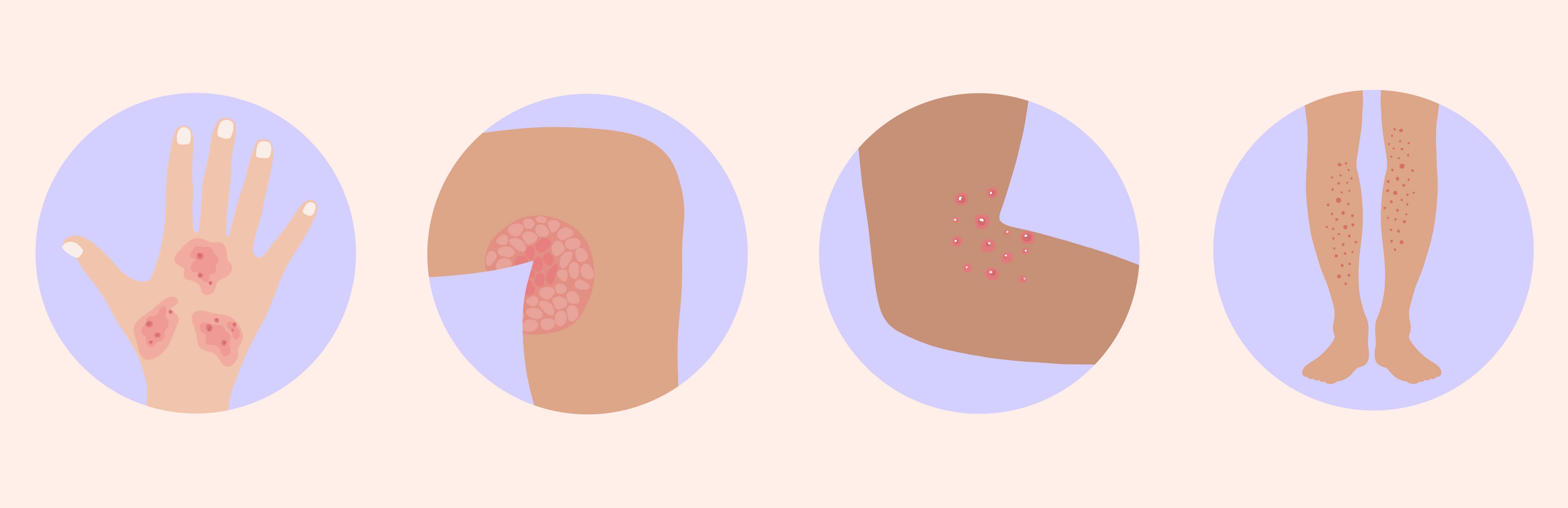 Eruptions cutanées