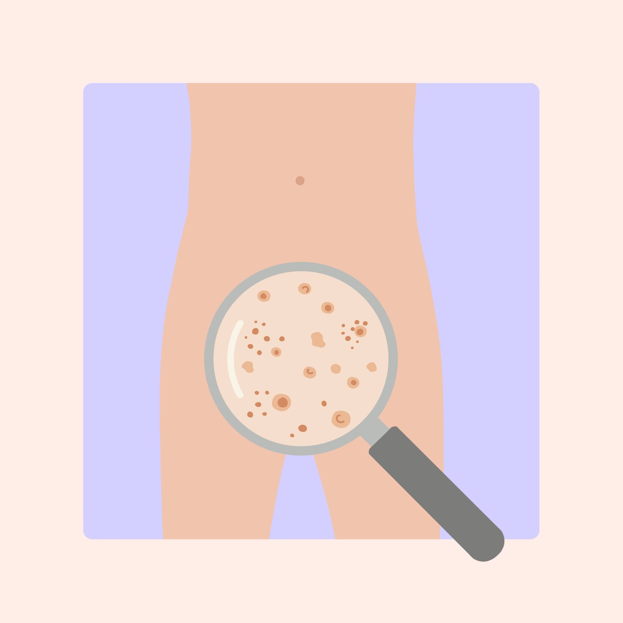condylomes reconnaitre