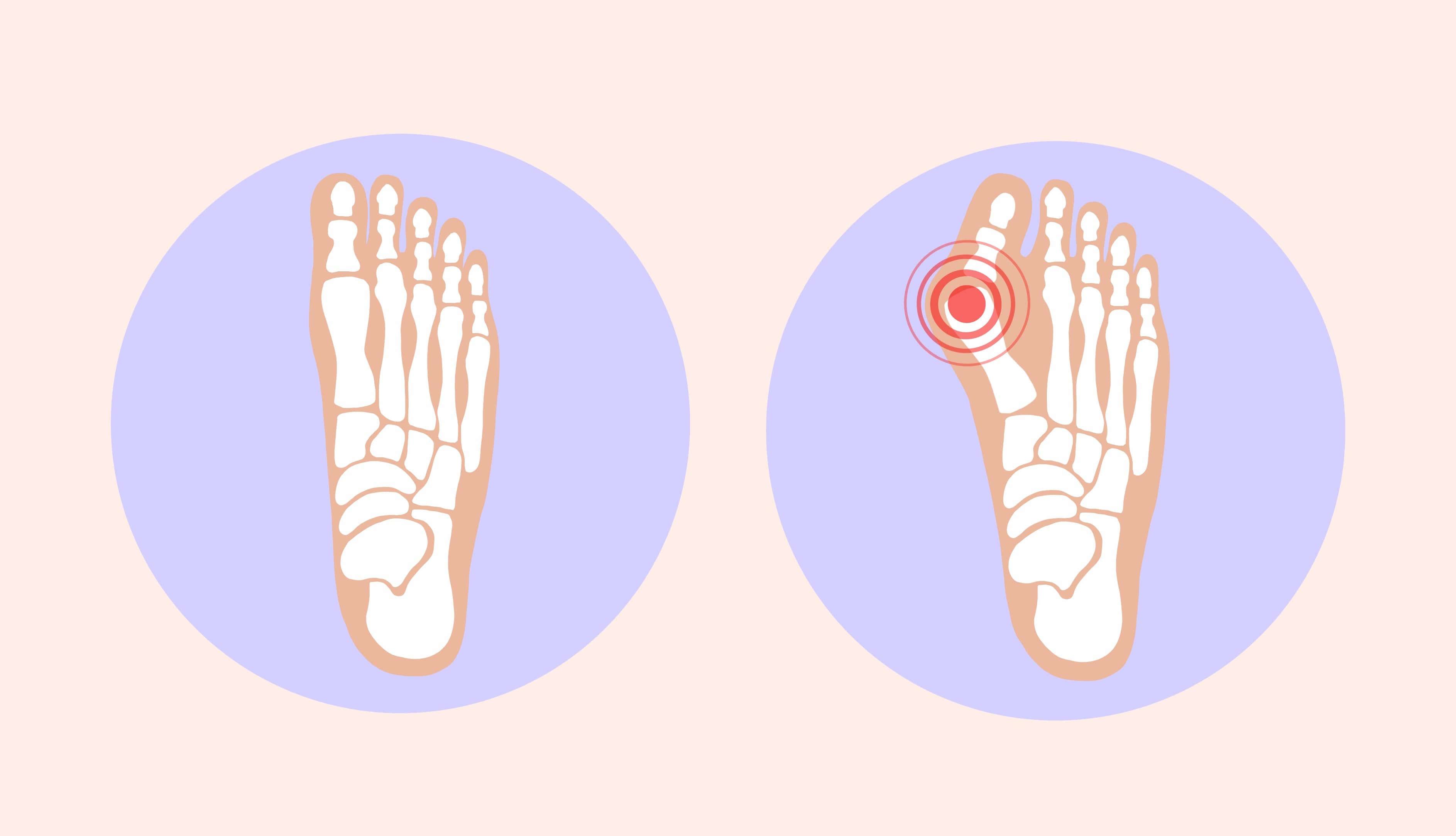 Wat is hallux valgus