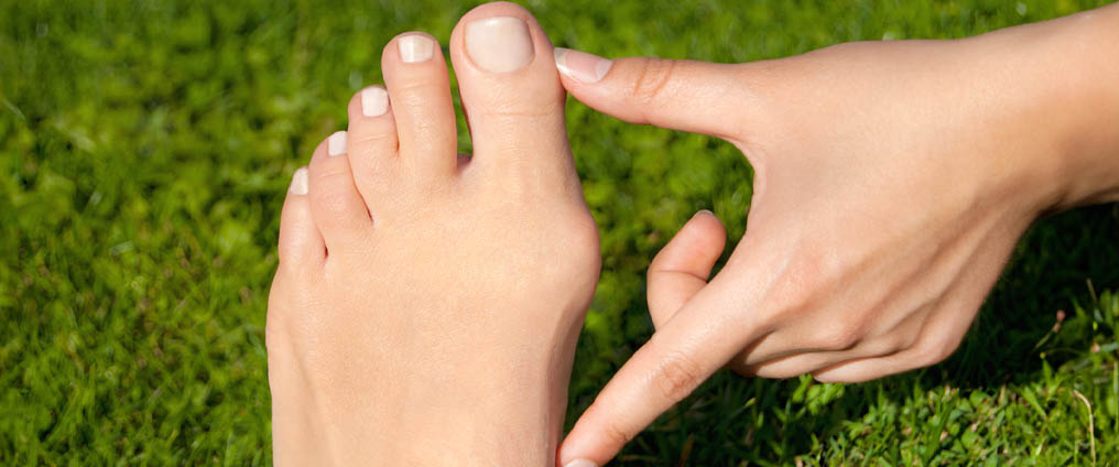 Hallux valgus: oorzaken, symptomen en behandeling