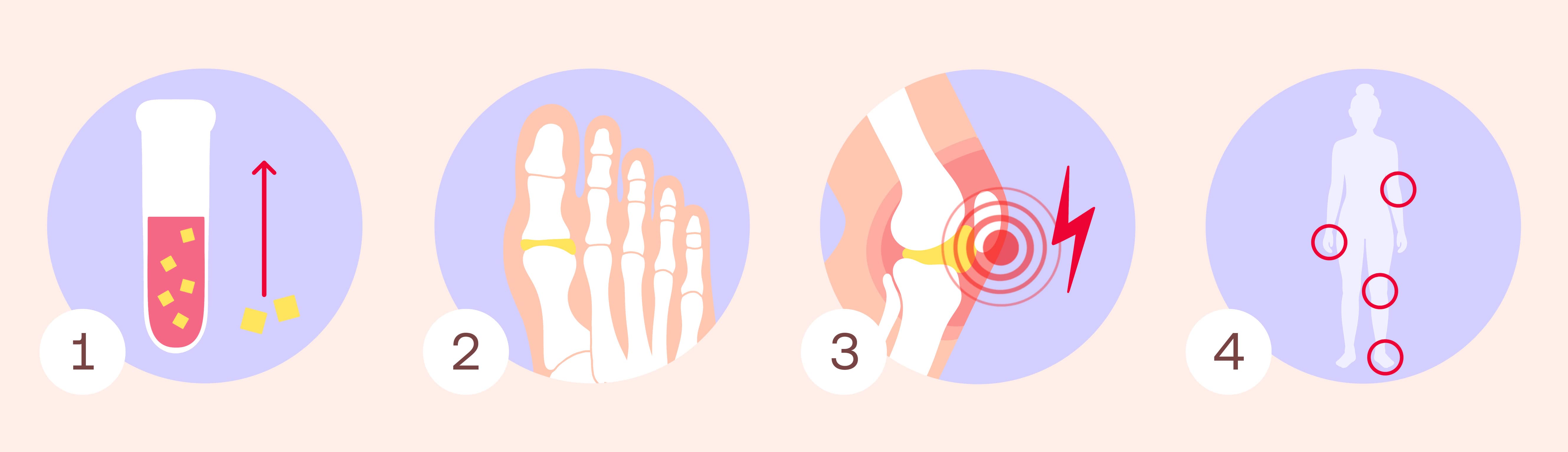 symptôme de la goutte