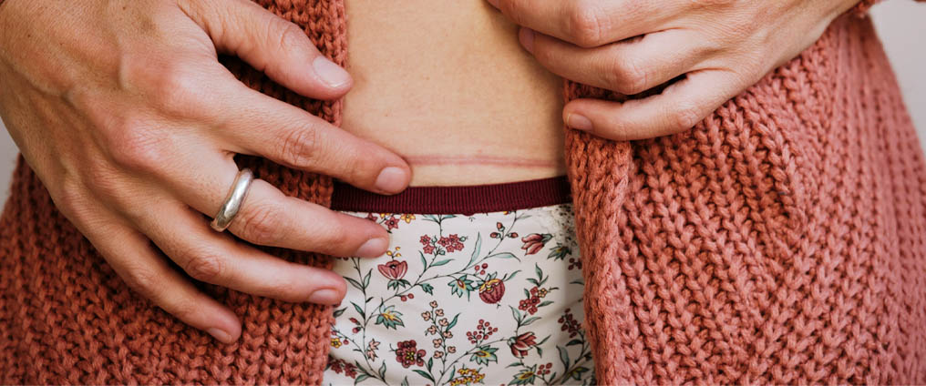Littekenbehandeling - Hoe voorkom je overmatige littekens?