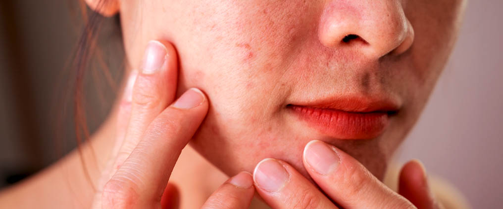 Peau impure - Quels soins adopter ?