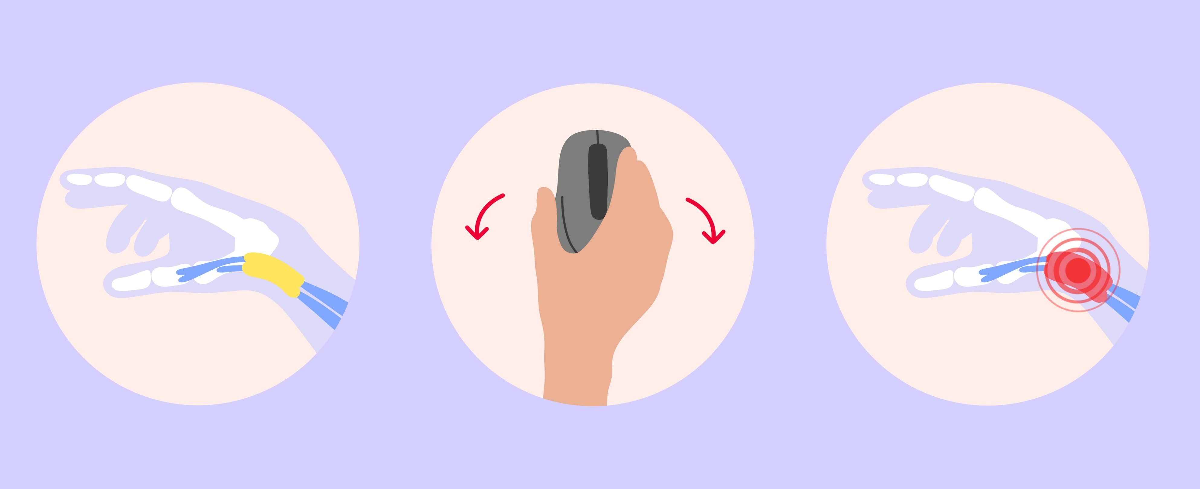 Oorzaak van peesontsteking