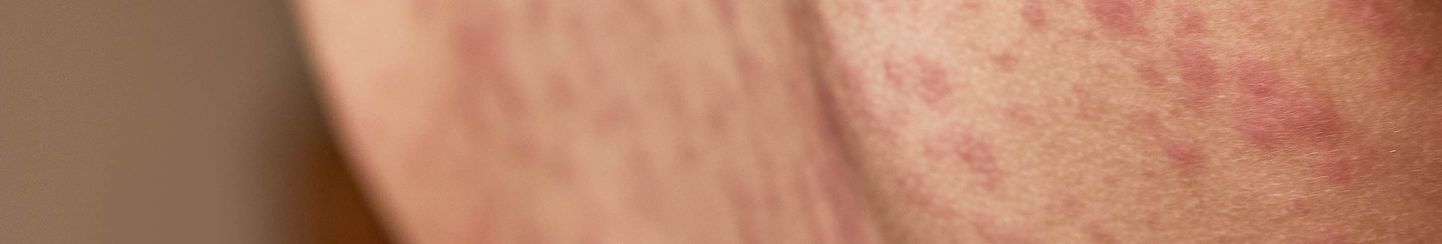 pityriasis rose header